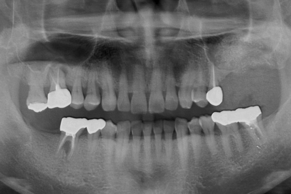 치아 를 제거 한 지 2 개월 후 #27