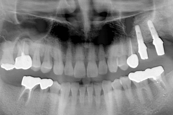 Implants were loaded with provisional crowns 2.5 months after placement (6.5 months after graft placement)