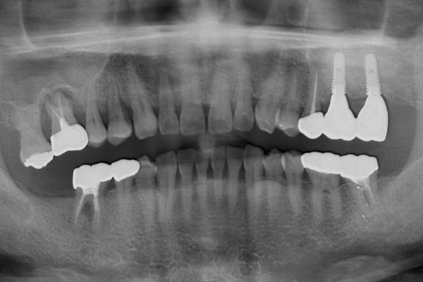 A Zirconia Bridge was placed 3 month after the provisional implants were placed (9.5 months after graft placement)