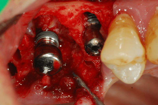#15, 16, 17, and 18 were removed followed by immediate implant