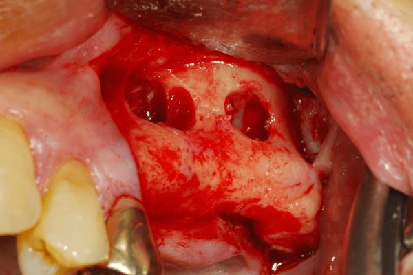 Sinus graft with BoneSigma™ BCP and InterOss® using the double window antrostomy approach
