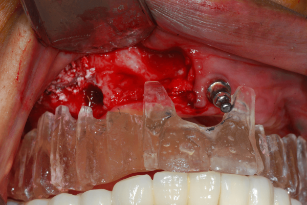Horizontale und vertikale Gratresorption in Bezug auf den chirurgischen Stent