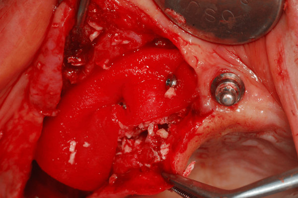 Maxilla allograft was performed using a 50:50 mixture of InterOss®and allograft