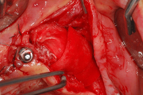 Le sinus maxillaire droit a été greffé avec BoneSigmaTMBCP et le sinus maxillaire gauche a été greffé avec InterOss®