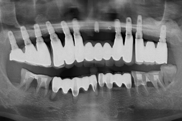 X-ray at 2 years shows a stable sate even with an unfavorable crown-implant ratio