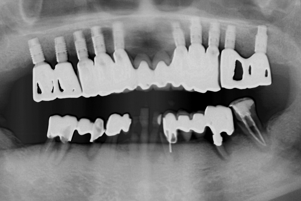Patient présenté avec les dents mobiles et la douleur mandibulaire