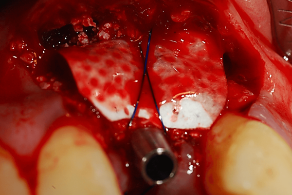 A collagen membrane was placed over the InterOss® granules