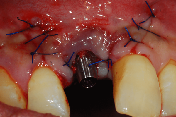 Site closure. The implant was immediately loaded with a temporary crown