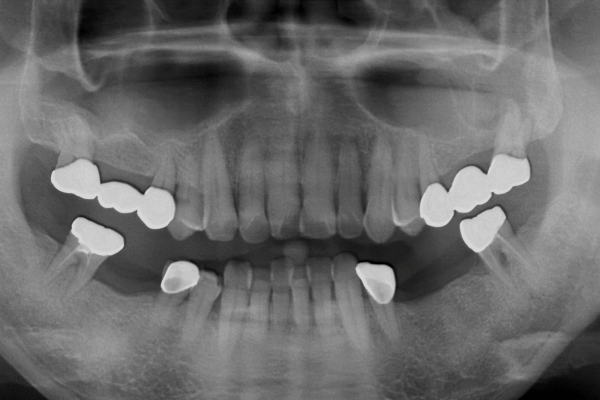 Patient mit schlechten #27 präsentiert und der Zahn wurde extrahiert