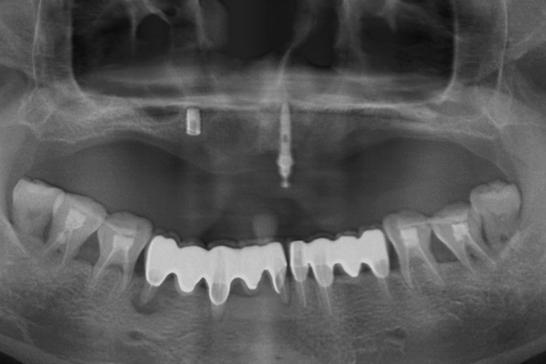Crête alvéolaire maxillaire fortement résorbée et état parodontal mandibulaire instable