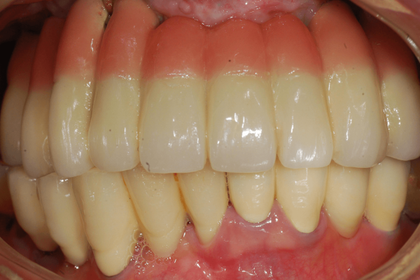 Pink porcelain was used to compensate the vertically resorbed alveolar bone ridge