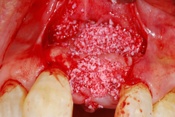 InterOss® was used to fill the boney defect and voids