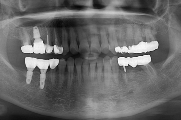 Zähne #35 und 37 müssen entfernt werden