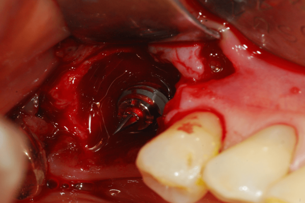 Colocación del implante inmediatamente después de la extracción #36
